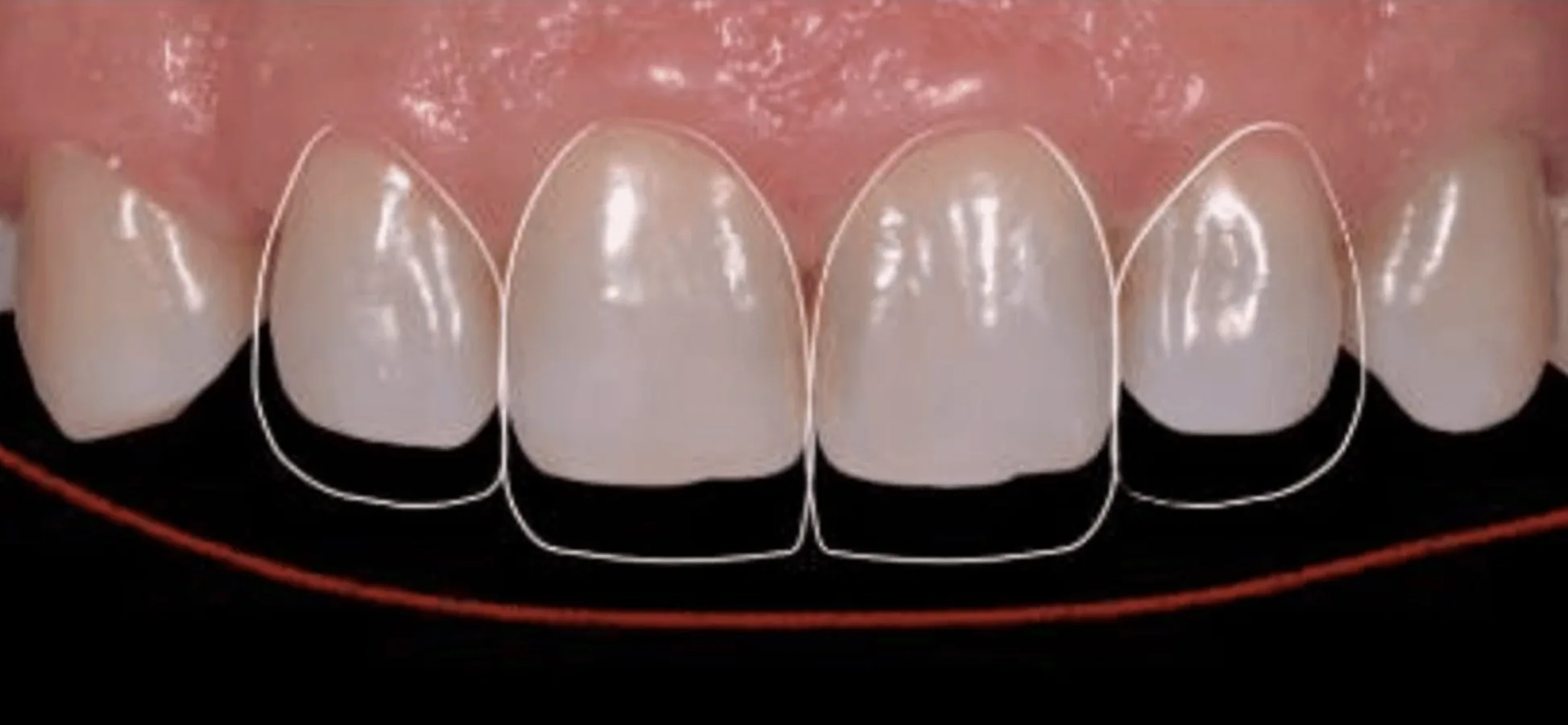 Digital Smile Design – dizajn osmeha