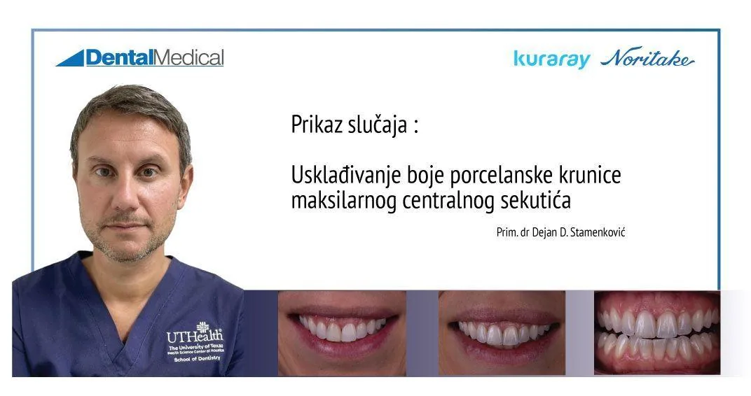 Prikaz slučaja: Usklađivanje boje porcelanske krunice maksilarnog centralnog sekutića