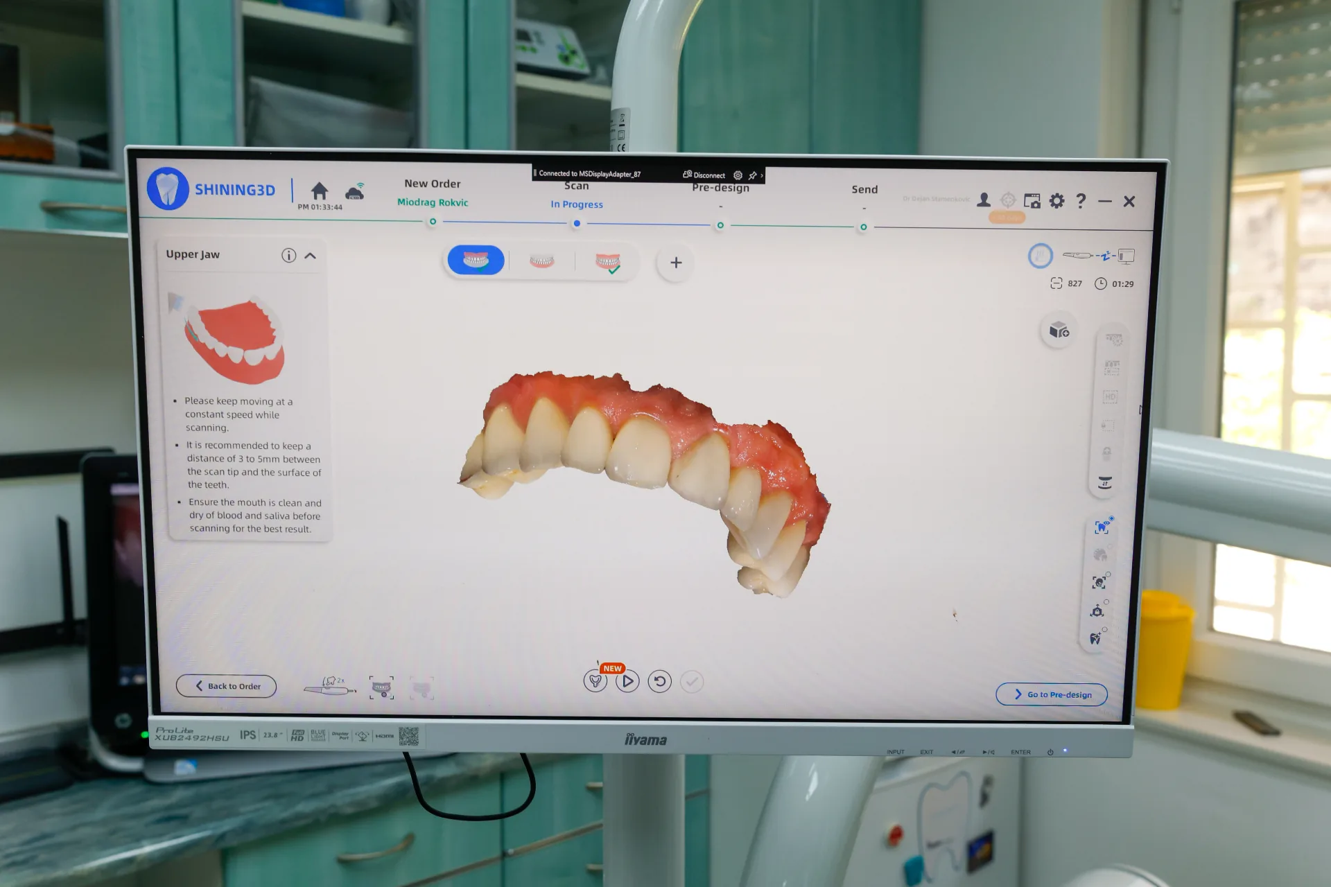 Digitalni 3D sken gornje vilice u softveru Shining3D