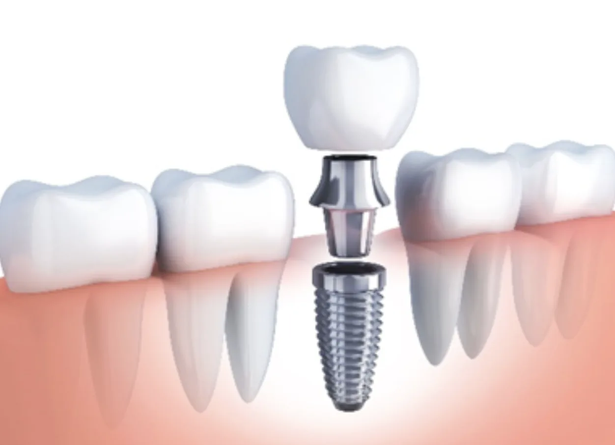 Dentalni implantat – ilustracija ugradnje implantata
